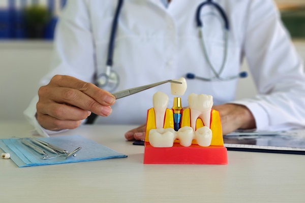 How The Dentist Prepares Teeth For Dental Crowns